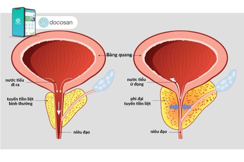 U xơ tiền liệt tuyến