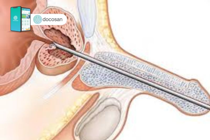 U xơ tiền liệt tuyến