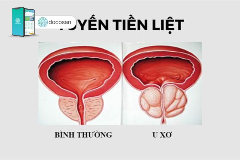 Vị trí tuyến tiền liệt