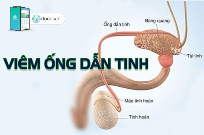 viêm ống dẫn tinh