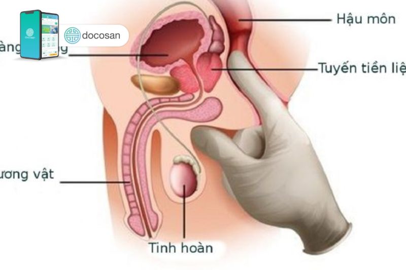 vôi hóa tuyến tiền liệt