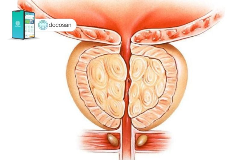 kích thước tiền liệt tuyến