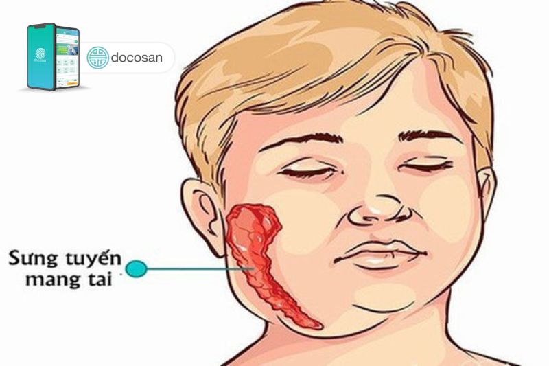 Triệu chứng bệnh quai bị ở trẻ em 