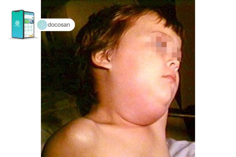 Triệu chứng bệnh quai bị ở trẻ em