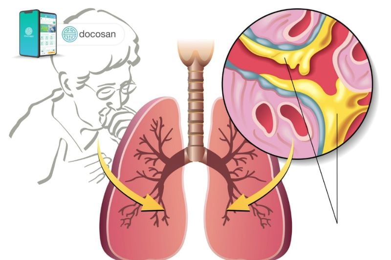 HO CÓ ĐỜM KÉO DÀI CẢNH BÁO NHIỀU BỆNH LÝ NGUY HIỂM NHƯ VIÊM PHẾ QUẢN HOẶC COPD