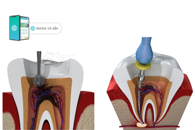 Răng cần lấy tủy sẽ được khoan lỗ (hình bên trái) để dụng cụ lấy tủy răng có thể tiếp cận được vùng tủy và loại bỏ phần bị nhiễm (hình bên phải).