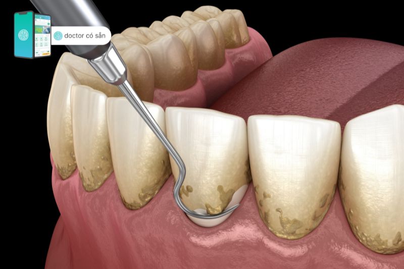 Mảng bám răng - nơi trú ẩn vi khuẩn có hại