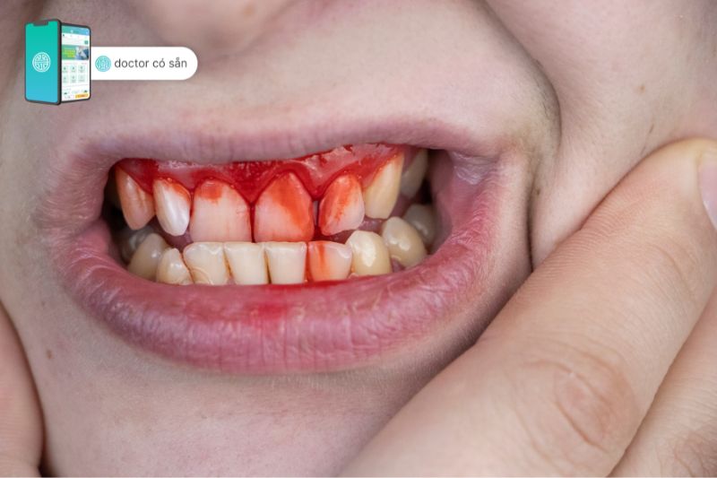 Viêm nha chu dễ gây chảy máu răng