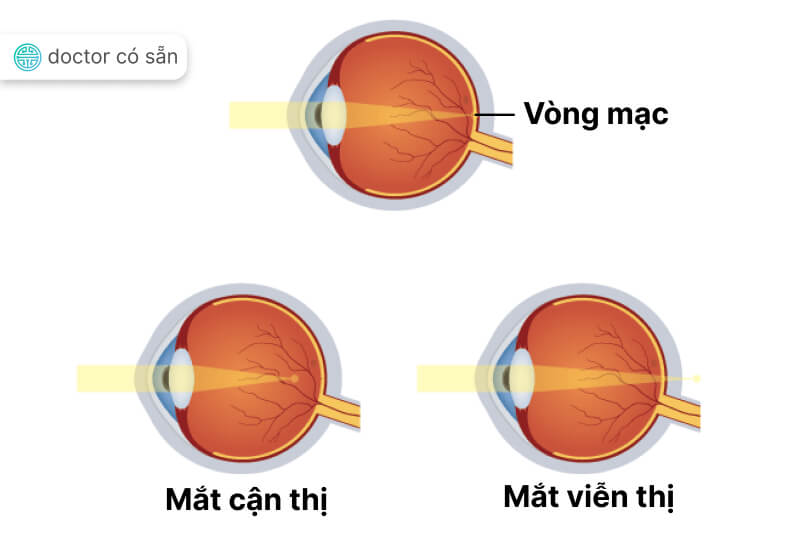 Khi bị cận thị, bạn có thể gặp khó khăn khi đọc bảng từ xa hoặc nhìn rõ các chi tiết xa.