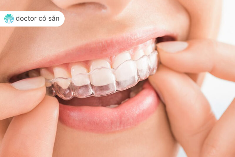 invisalign in vietnam 2