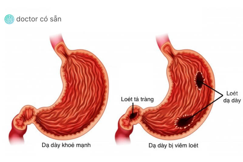 Viêm loét dạ dày có thể gây đi ngoài phân đen