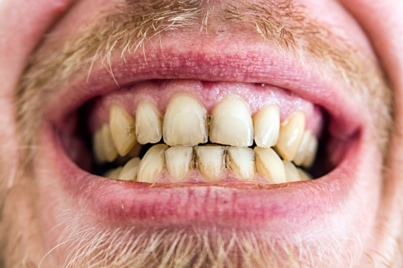tại sao đánh răng thường xuyên mà răng vẫn vàng