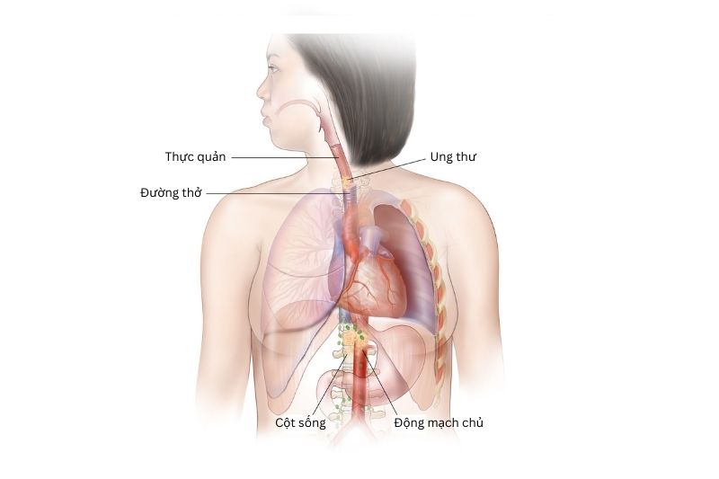 Ung thư thực quản giai đoạn cuối đã lan vào các cấu trúc lân cận như đường thở, động mạch chủ hoặc cột sống
