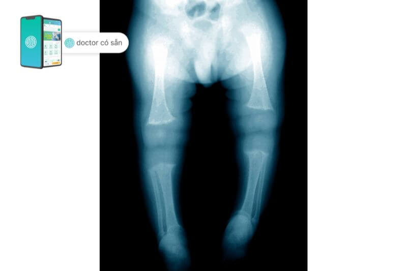 Có thể chẩn đoán chân vòng kiềng do bệnh Blount bằng X - quang
