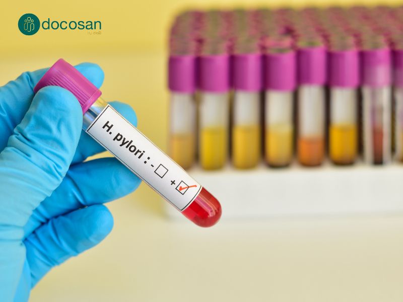 Helicobacter Pylori là nguyên nhân hàng đầu gây viêm loét dạ dày