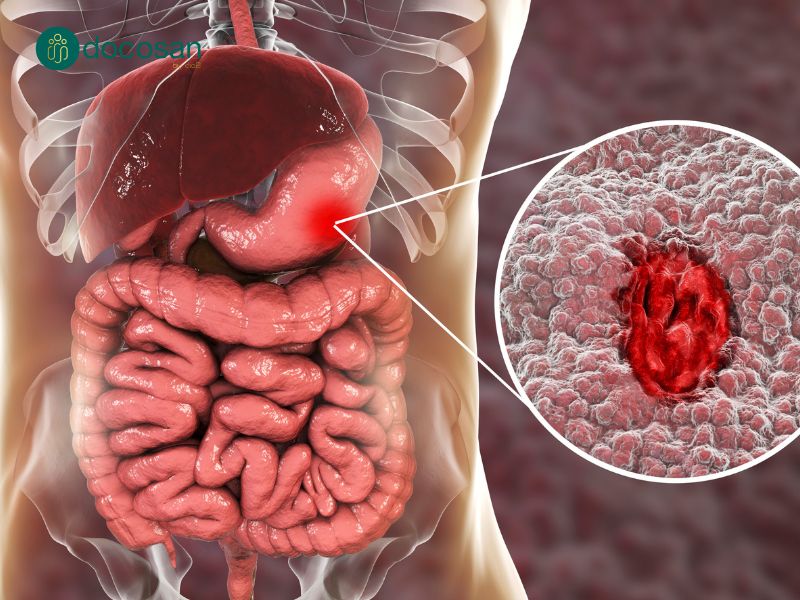 Viêm loét dạ dày