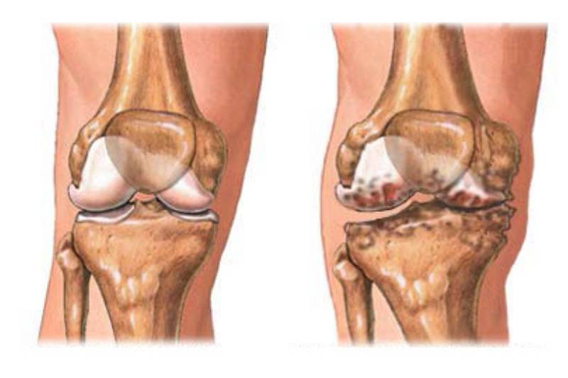 Khớp khối ở người bình thường (bên trái) và người bệnh viêm xương khớp (bên phải) (Nguồn: Foothills Family Care)