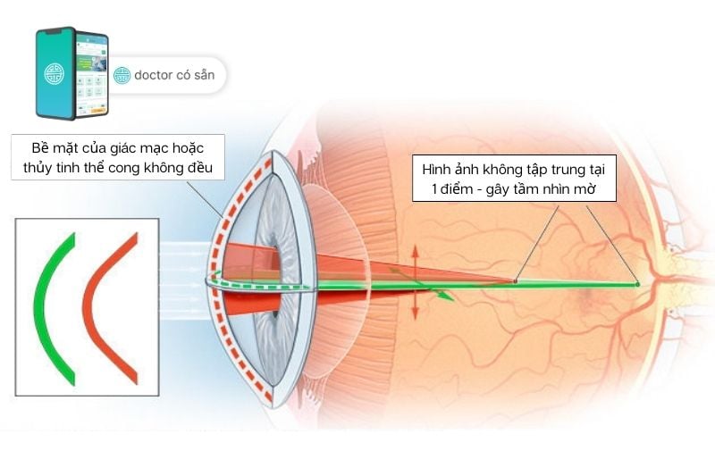 Mắt loạn thị có bề mặt giác mạc và thủy tinh thể cong không đều