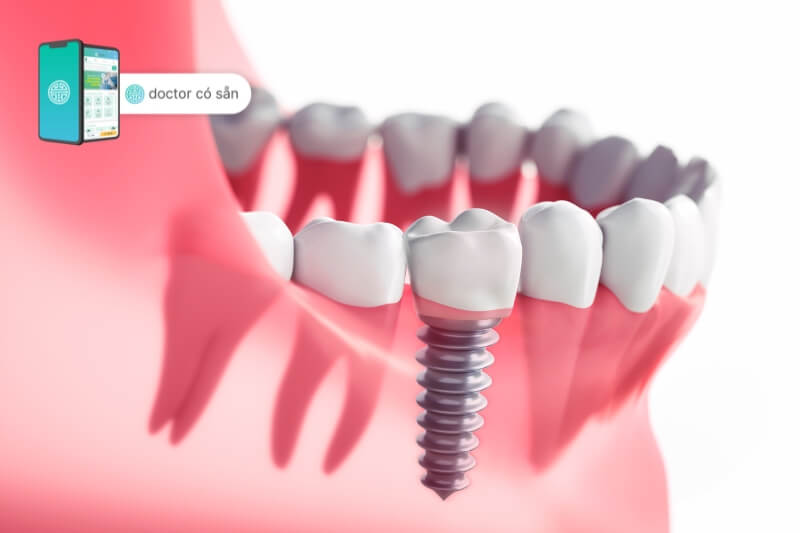 Trồng răng implant là phương pháp hiệu quả lâu dài
