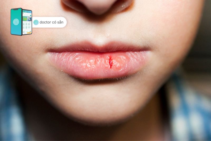 Tiêm filler môi có thể gây chảy máu, sưng, đau nếu kỹ thuật không tốt