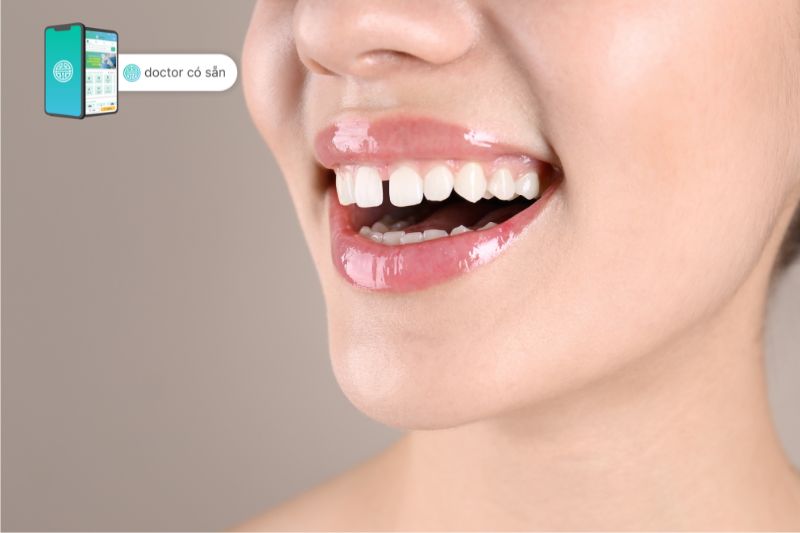Niềng răng invisalign điều trị răng thưa hiệu quả