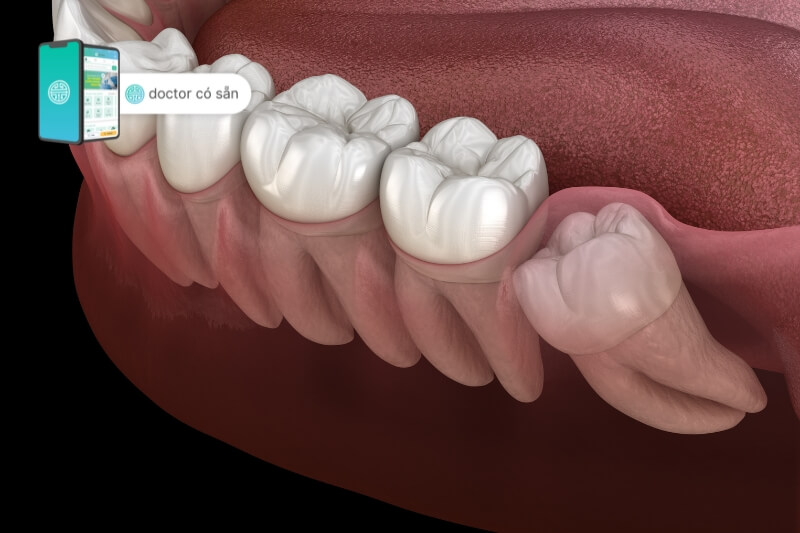 Răng khôn mọc lệch là nguyên nhân cơ bản làm sưng chân răng hàm dưới