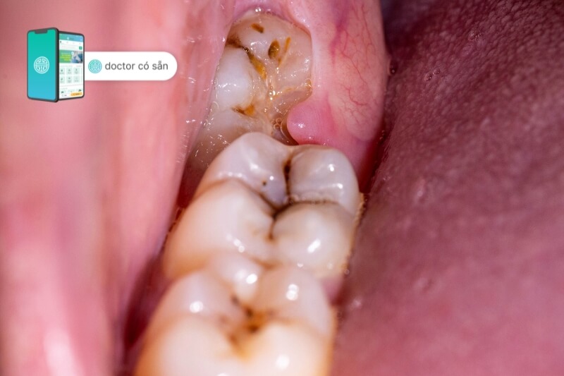 Dấu hiệu đau nhức của sưng chân răng hàm dưới 