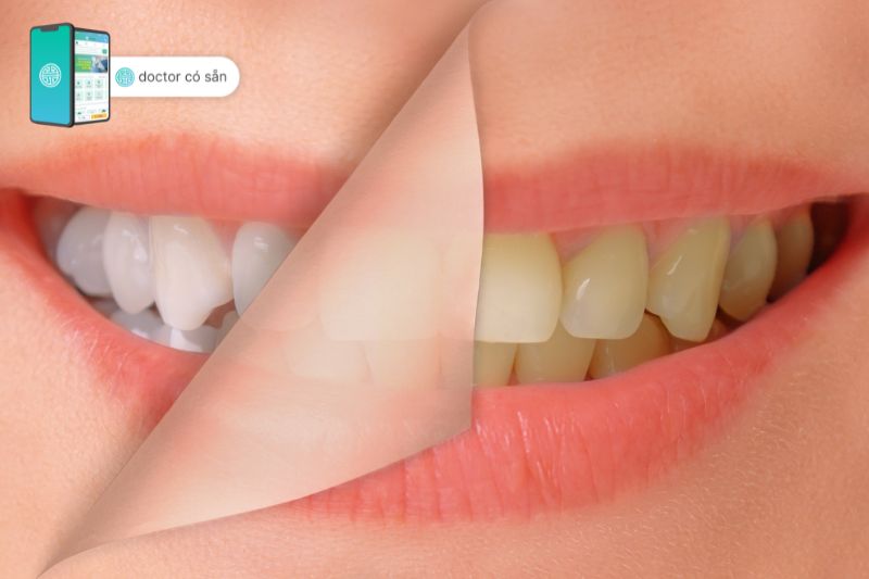 Trồng răng sứ cải thiện màu răng