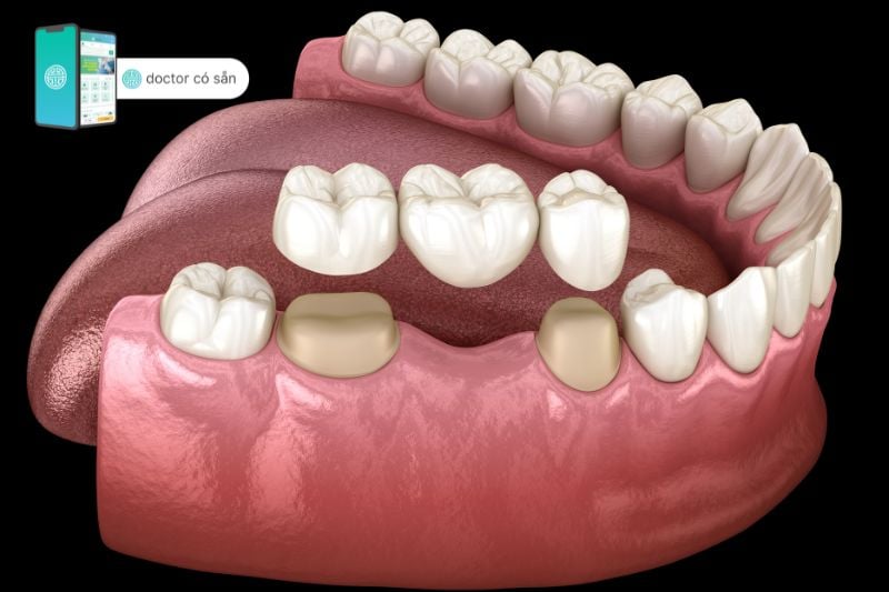 Trồng răng sứ giúp phục hồi răng bị mất