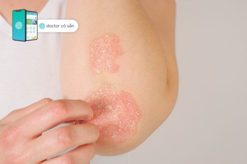 Psoriasis is more than just a skin issue; it goes beneath the surface