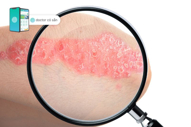 Psoriasis - A complex skin condition with red, scaly patches, influenced by various factors