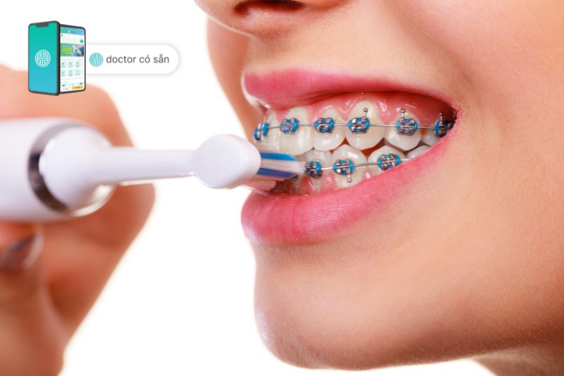 Chú ý giữ vệ sinh răng miệng sạch sẽ khi niềng răng khểnh