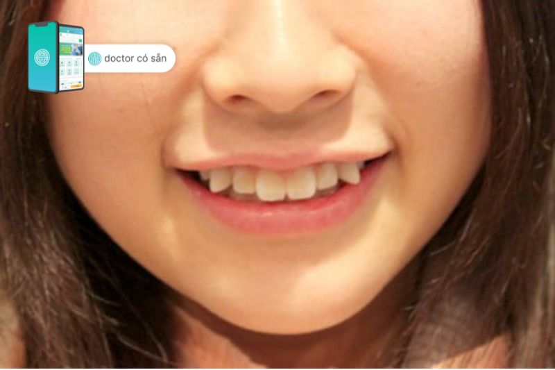 Răng khểnh được coi là một nét duyên trên gương mặt, tuy nhiên đối với sức khỏe răng miệng, răng khểnh tiềm ẩn những nguy cơ gây hại