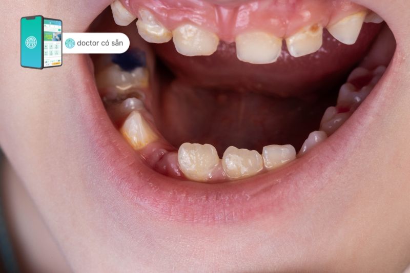 Răng sữa mất quá sớm có thể khiến răng khấp khểnh