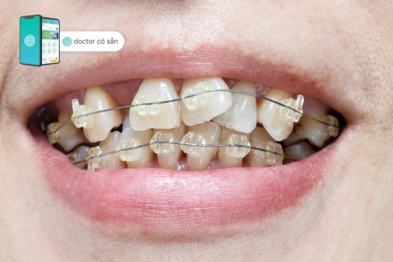 Niềng răng là phương pháp điều trị hiệu quả tối ưu cho tình trạng răng khấp khểnh