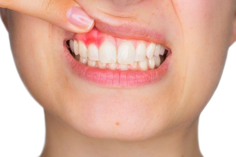 Viêm nhiễm nướu là một trong những nguyên nhân thường gặp gây sưng chân răng hàm trên