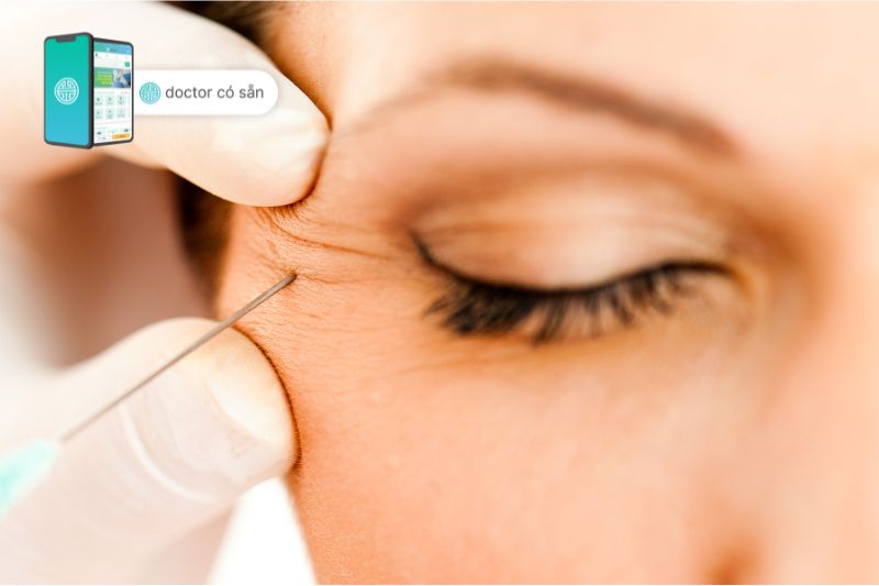 Tiêm filler có thể xóa vết chân chim hiệu quả