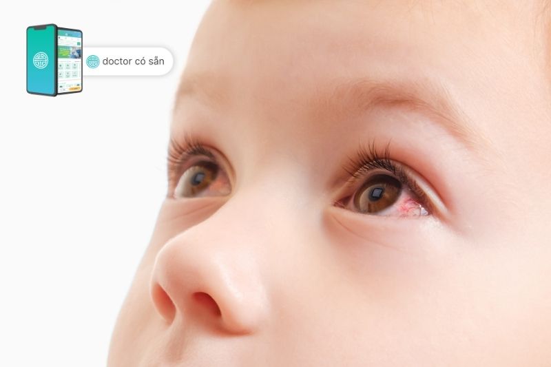 Bệnh đau mắt đỏ ở trẻ em có thể gây ra một số biến chứng nguy hiểm