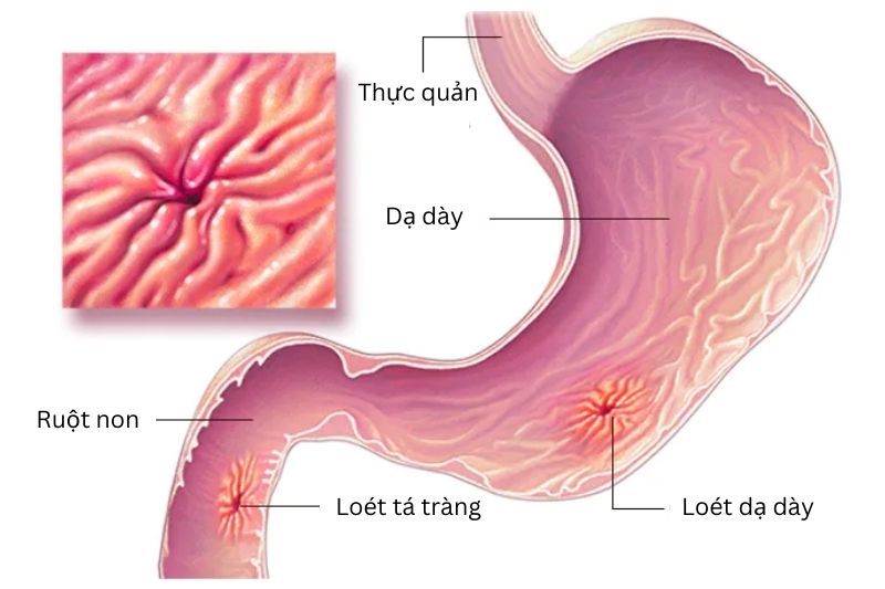 Viêm loét dạ dày tá tràng