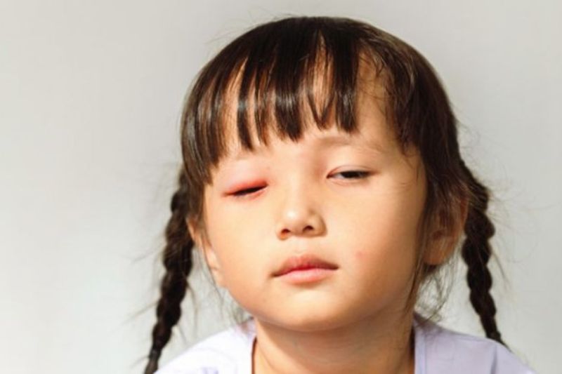 Cần tuân thủ điều trị của bác sĩ để khỏi bệnh đau mắt đỏ nhanh chóng nhất