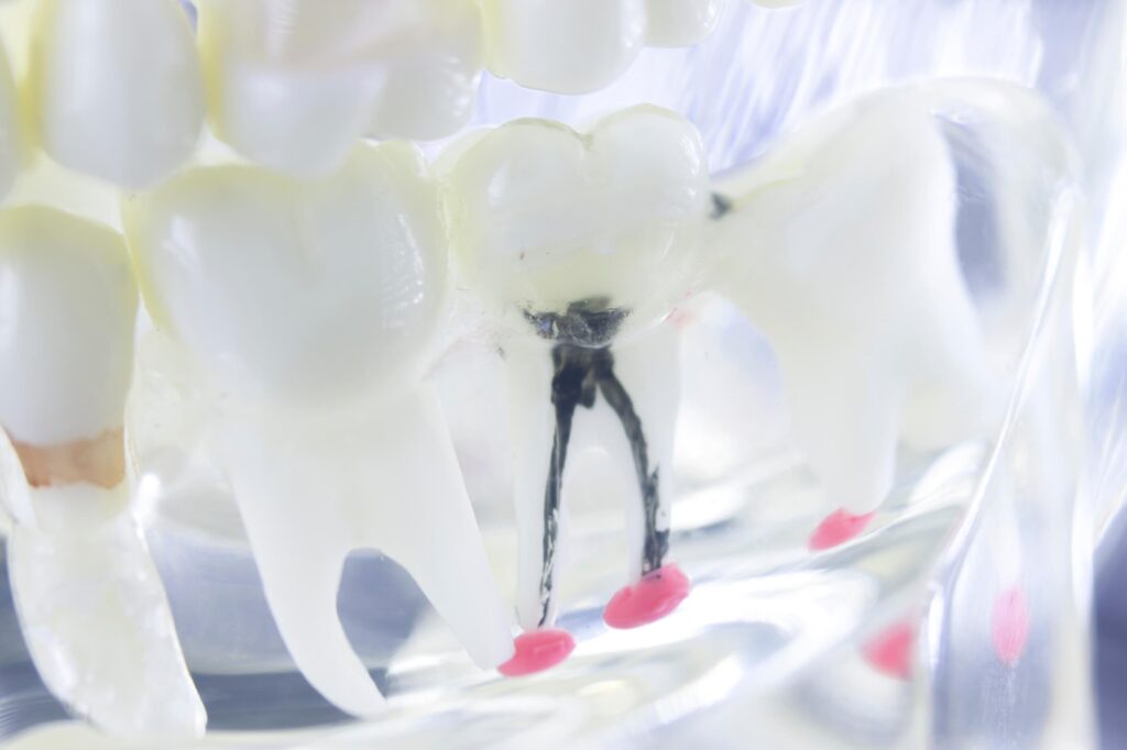 Răng bị sâu trong thời gian dài không điều trị sẽ làm ảnh hưởng đến hệ thống tủy