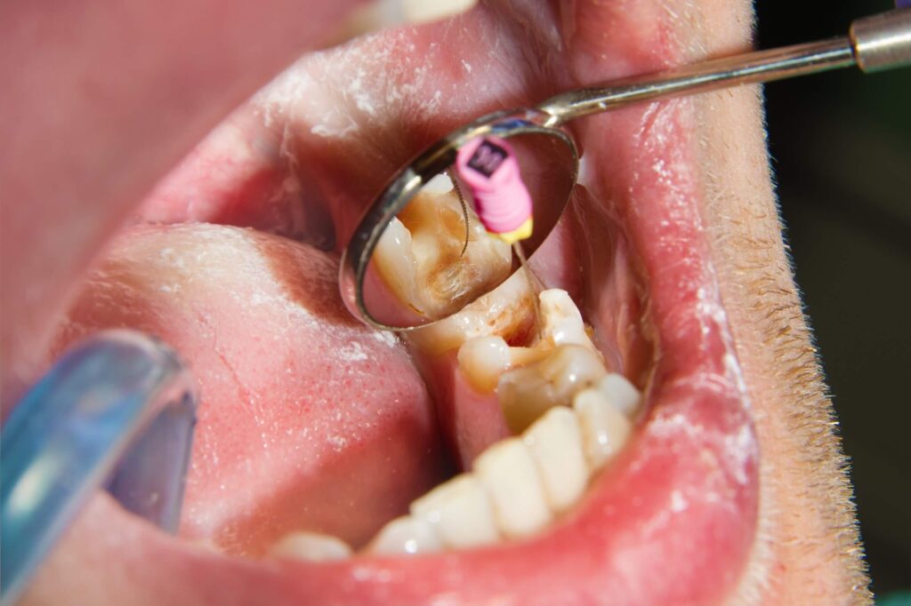 Mục đích của việc lấy tủy răng là cải thiện tình trạng đau đớn và phòng ngừa răng trở nên nghiêm trọng hơn