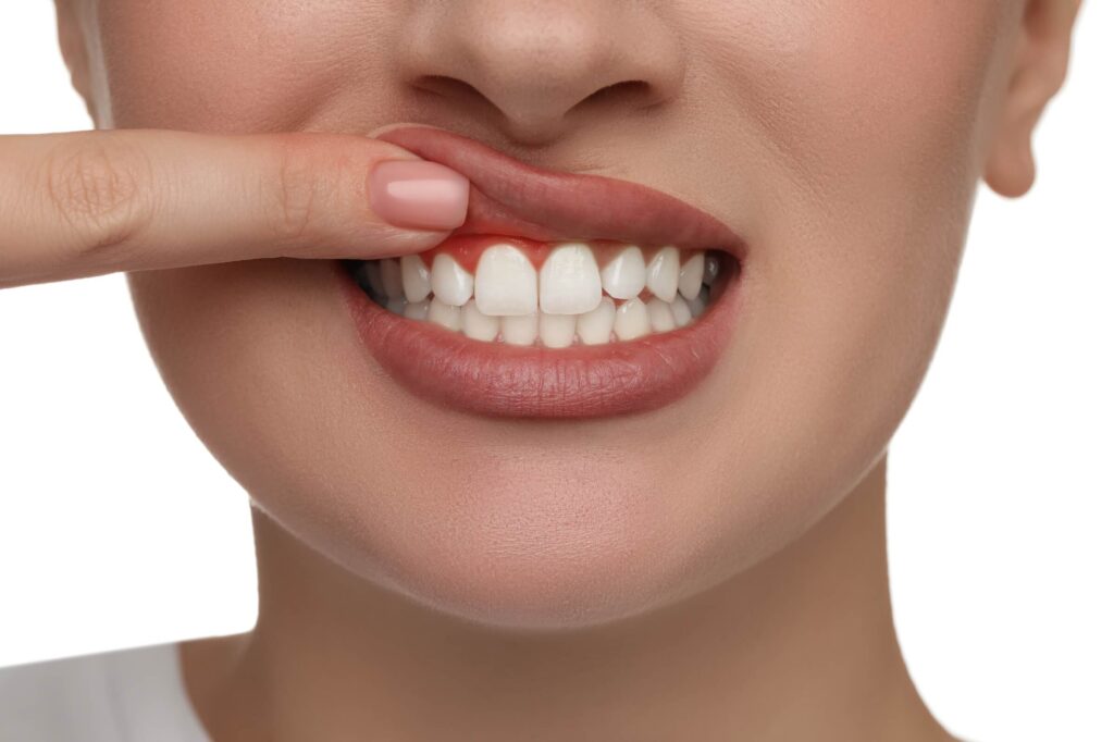 Lấy tủy răng có thể gây sưng nướu răng