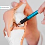 phục hồi chức năng dây chằng chéo trước