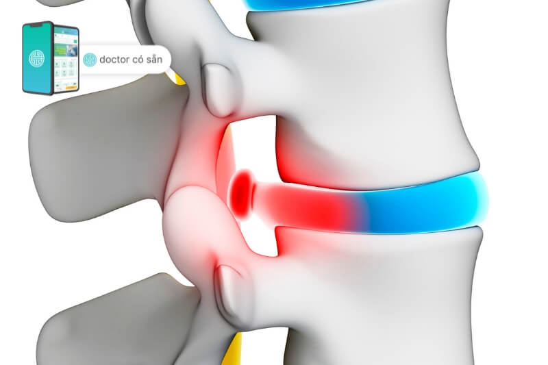 Nguyên nhân thoát vị đĩa đệm cổ 
