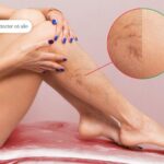 cách chữa giãn tĩnh mạch