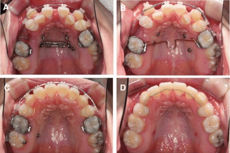 trước và sau khi niềng