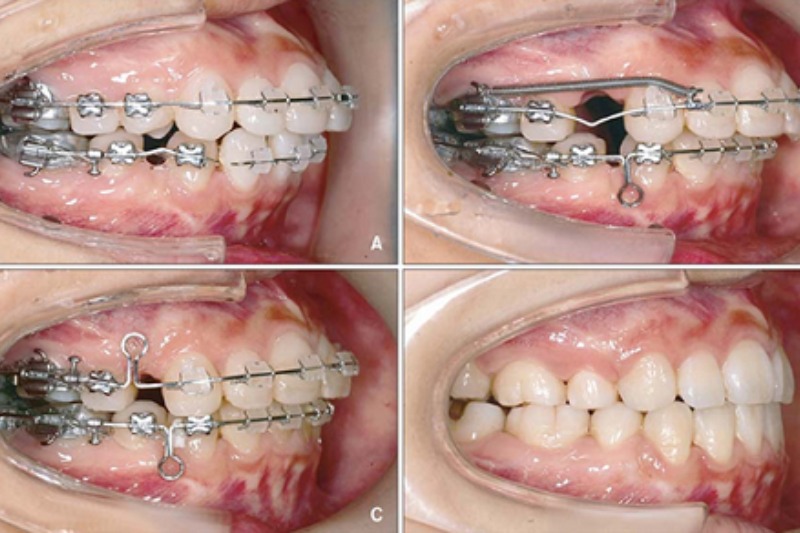 trước và sau khi niềng