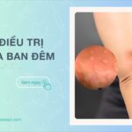 Nổi mẩn ngứa khắp người vào ban đêm do đâu Cách điều trị hiệu quả