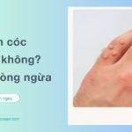 Mụn cóc là một vấn đề da liễu phổ biến, nhưng đến nay nhiều người vẫn thắc mắc rằng "mụn cóc có lây không"?